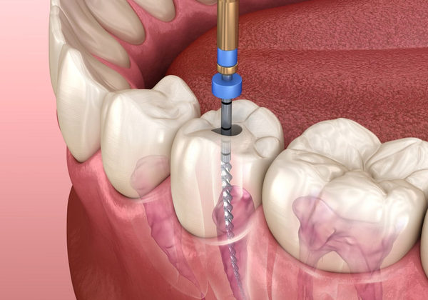 Root canal treatment