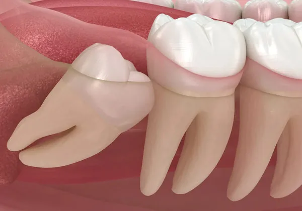 Wisdom tooth assessment