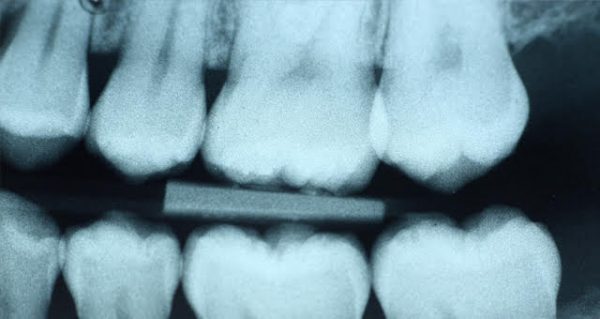 Picture Of A Dental X-Ray